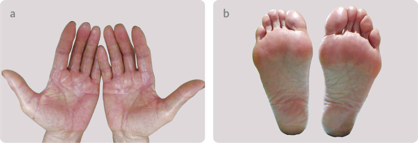 軽度の手足症候群の例（手と足）