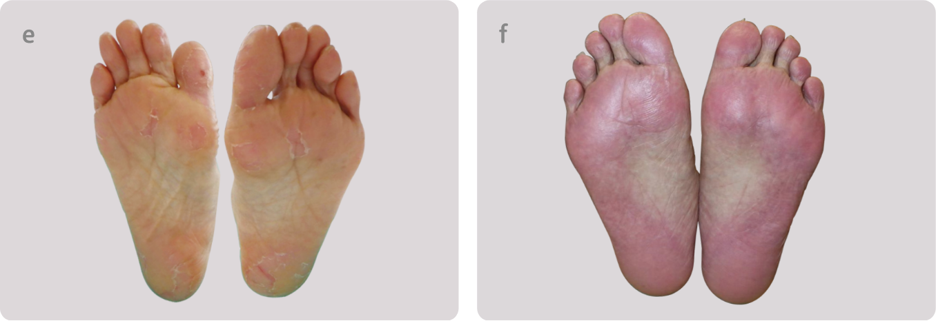 中等度の手足症候群の例（足）