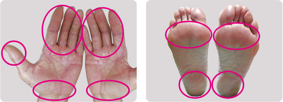 手と足で手足症候群が現れやすいところの例