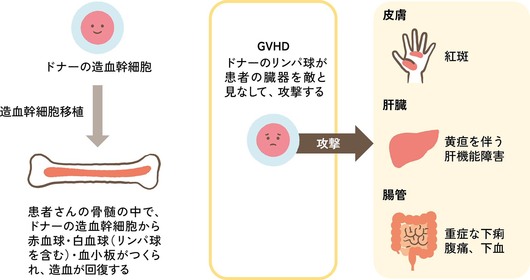 図2. GVHDが起こるしくみ