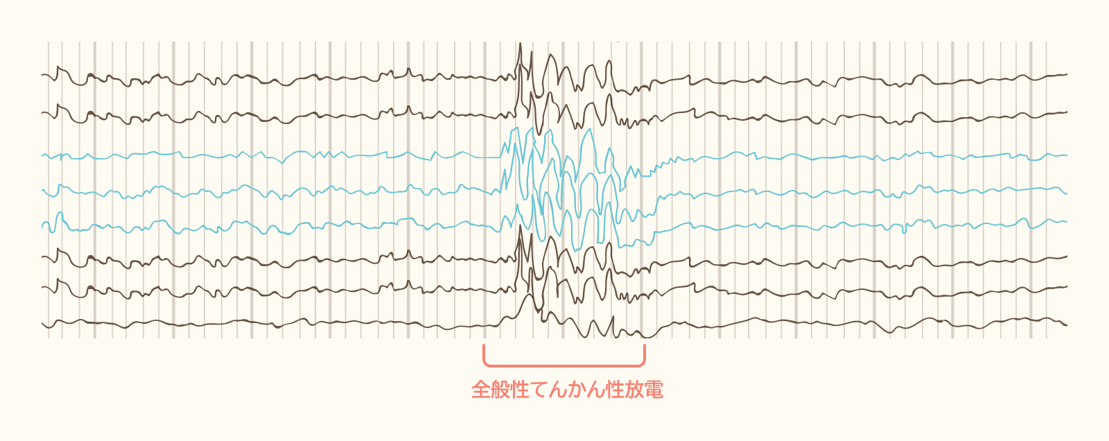 全般性てんかん性放電